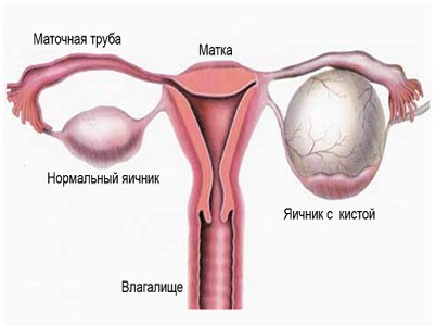 Киста желтого тела яичника: симптомы, диагностика и лечение в Москве